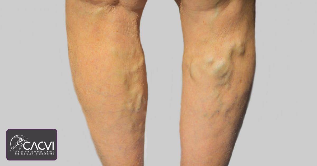 Understanding Varicose Veins Stages & Treatment Options