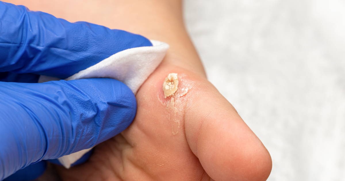 Close-up of a wart being treated by a dermatologist