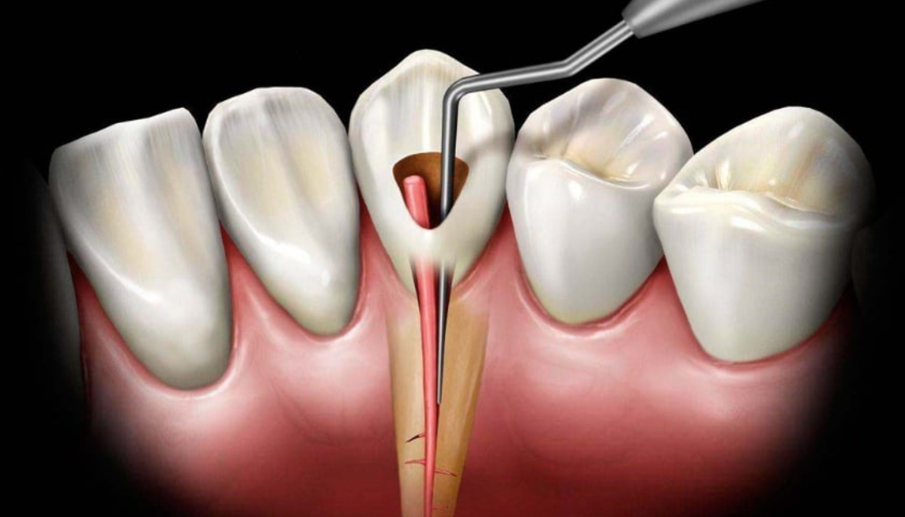 Illustrasjon av rotfylling og rengjøring av rotkanal før oppbygging.