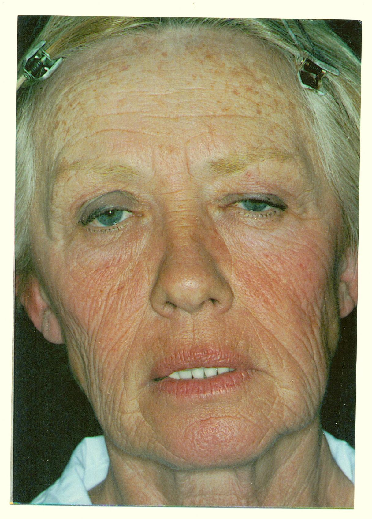 Full Facelift including browlift,eyelid surgery and Laser resurfacing - Before