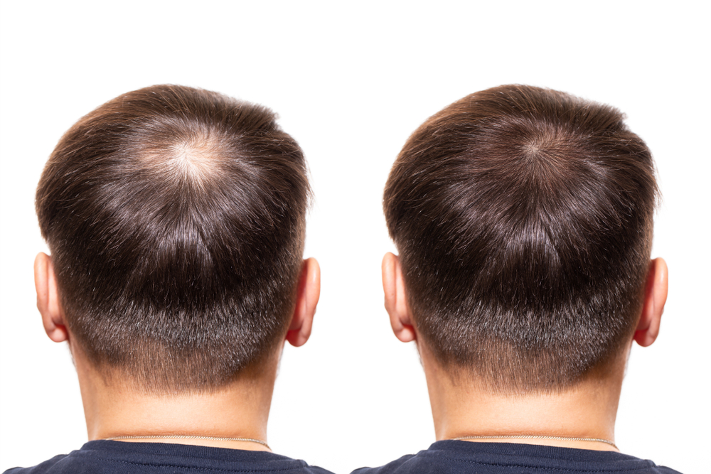 Before and after picture of a man's hair, showing thinning at the crown (before) and better crown coverage (after).