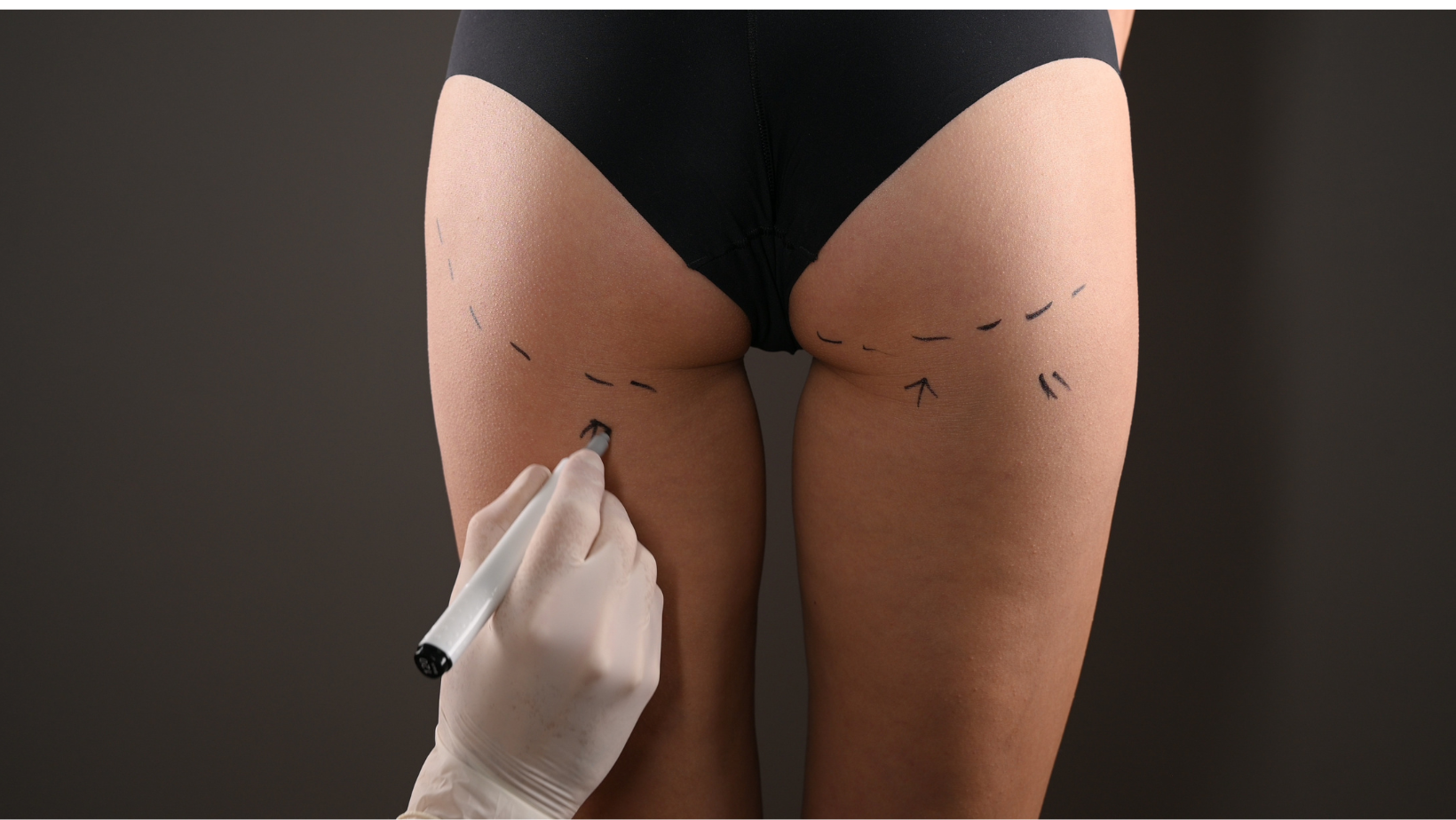 How Long Does a Brazilian Butt Lift Last? Factors affecting the logevity of a brazilian butt life procedure