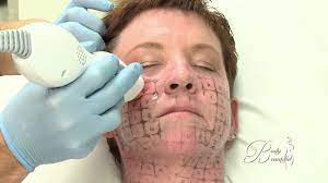 Thermage procedure - YouTube