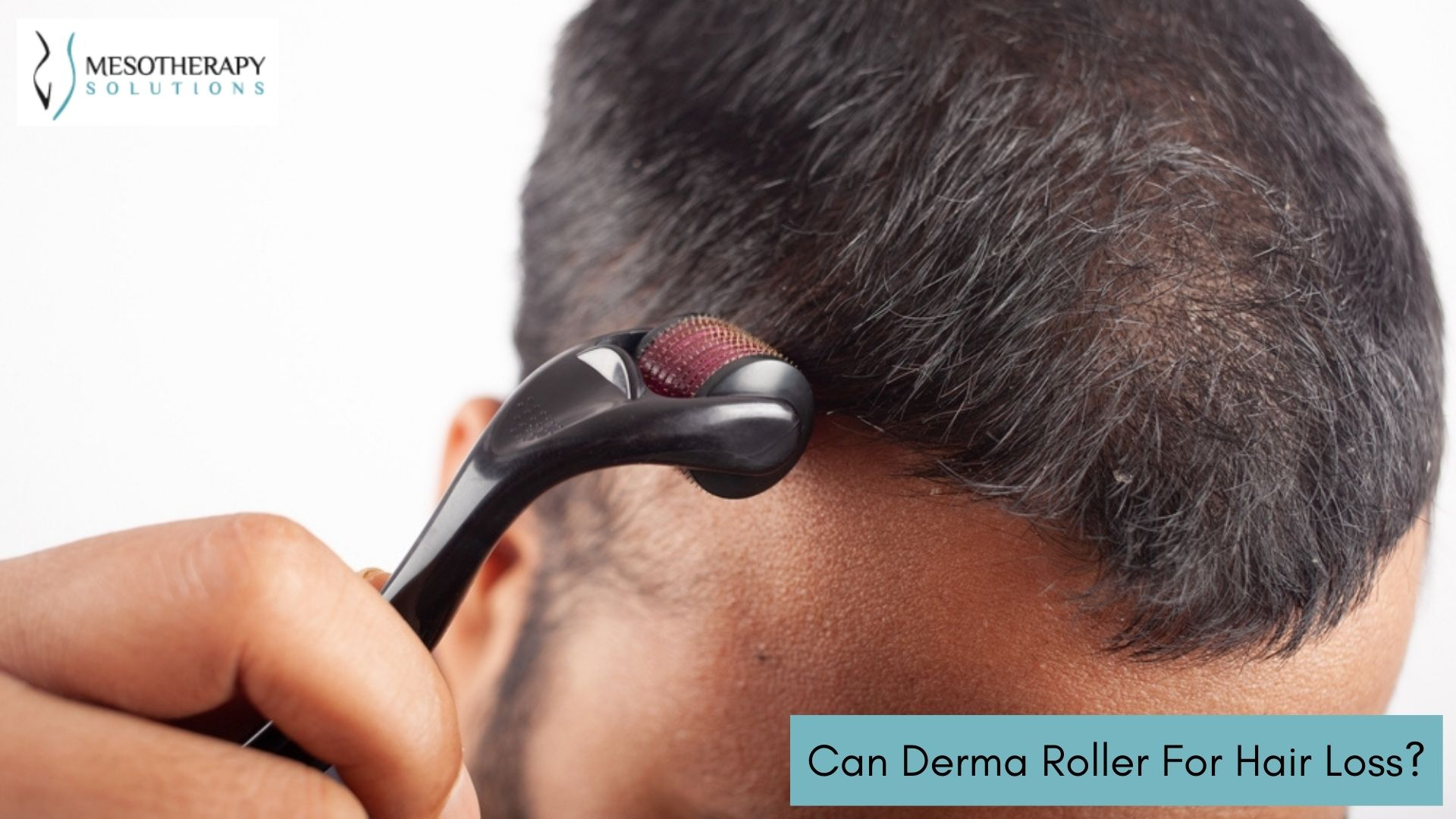 Dermaroller for Hair Loss: An In-depth Guide - Hairverse