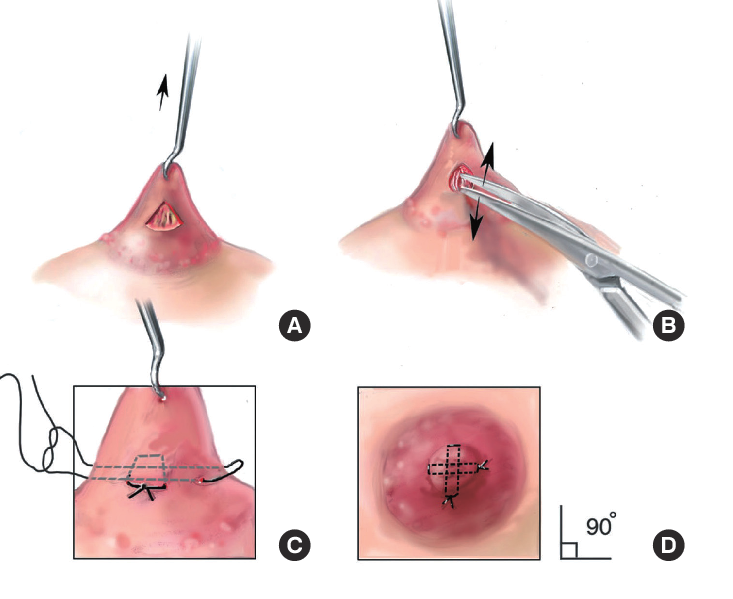 Ilustración de técnicas quirúrgicas para la corrección del pezón.