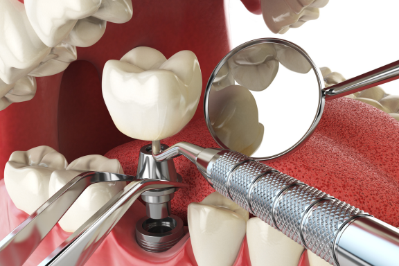 illustration of the parts of a dental implant and how the titanium metal post is placed in the jawbone 