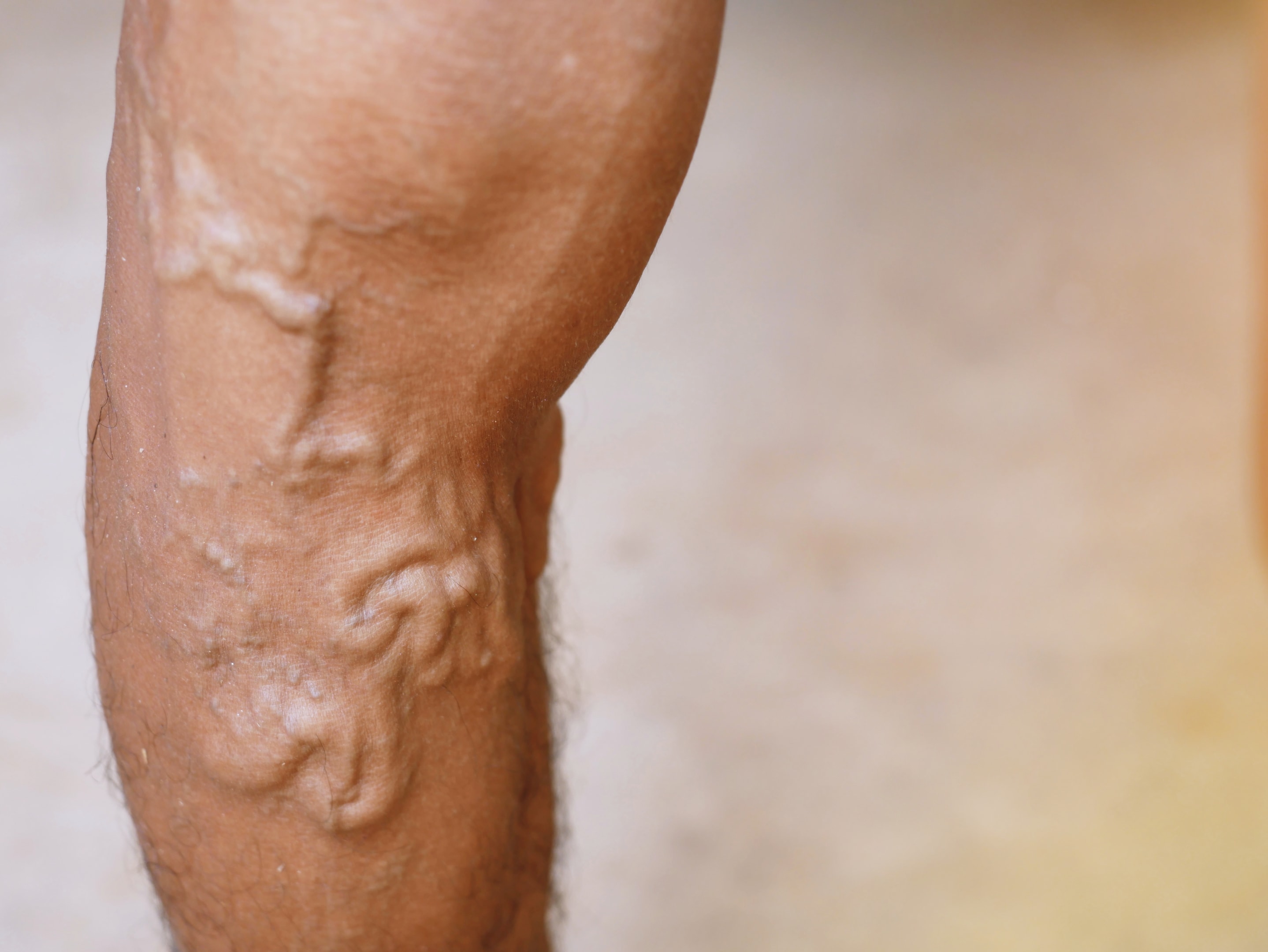 Close-up photo of a leg with bulging varicose veins, prominently showing enlarged, twisted veins just beneath the skin's surface.