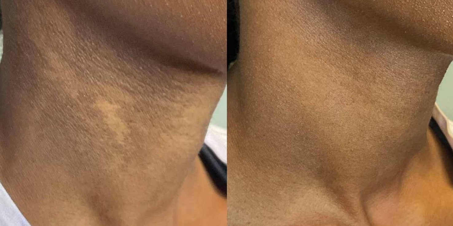Treated area on neck showing improved tone after MOXI treatments, part of a skincare journey led by a healthcare professional in cosmetic treatments.
