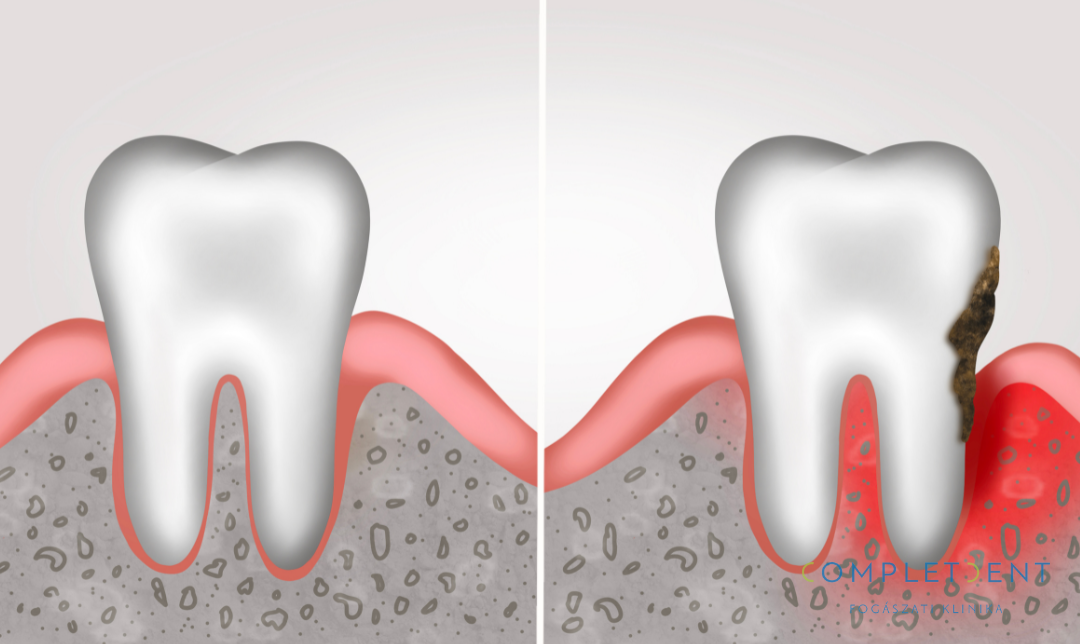 Kezeletlen esetben akár a fogágy további betegsége is kialakulhat. 