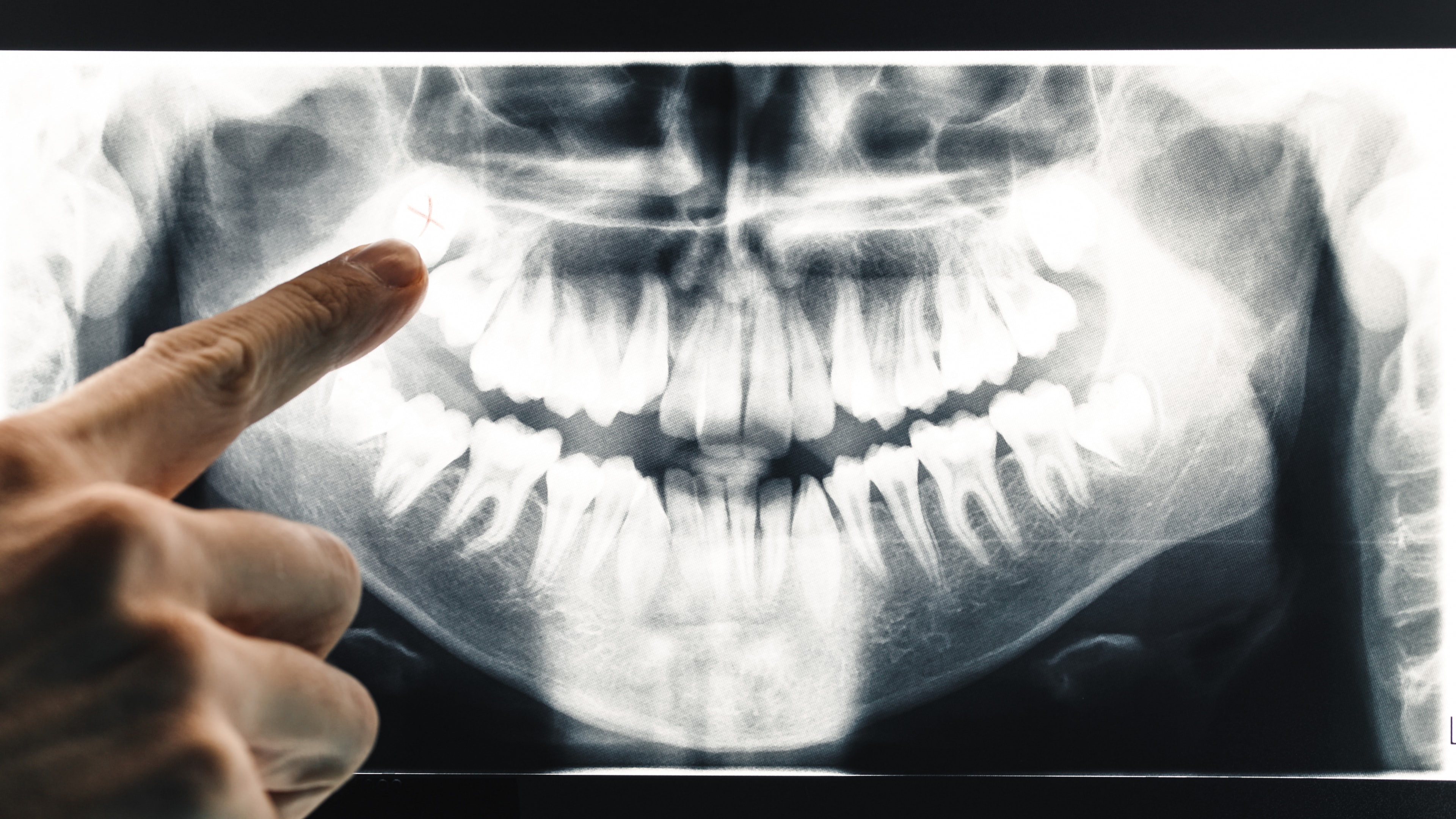 x-ray showing where here will be a wisdom tooth extraction