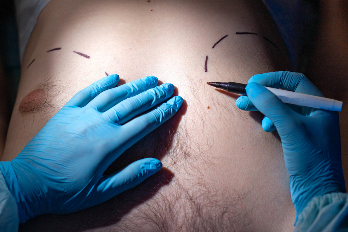 A picture of a male patient demonstrating receiving a surgery procedure - not an actual patient