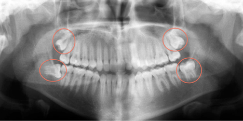 X-ray showing where wisdom teeth are