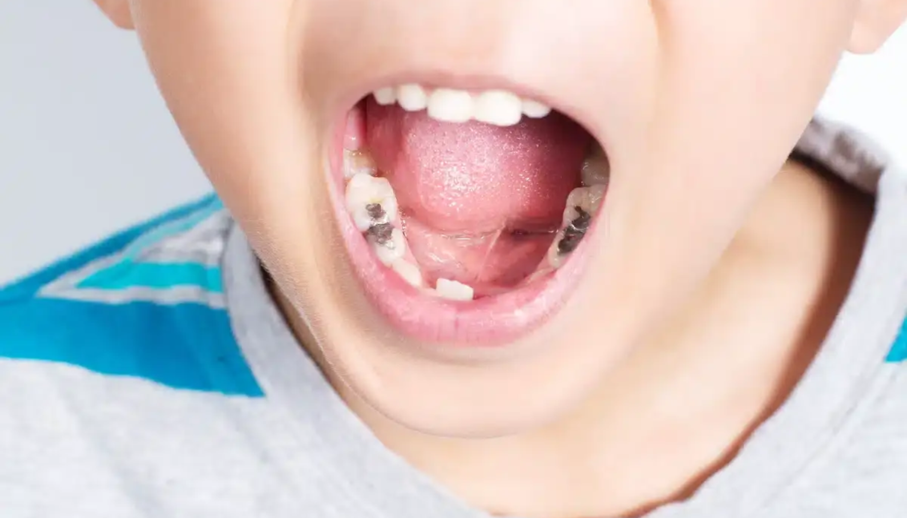 Nærbilde av barns åpne munn som viser flere hull og misfargede jeksler, tegn på alvorlig tannråte. vondt i tann etter boring hos tannlegen tannen får vondt fylling tann tannverk vondt tenner fyllinger betennelse tannlegen hull nerven dersom tennene smerter fyllingen behandling ofte bør normalt får bakterier flere tannlege rotfylling gir smerten tid viktig store gjør kommer årsaker smerte lenge tilfeller hullet kontakt nødvendig uker vanlig gjøre andre oppstår går litt fjerne munnen komme igjen hos behandlingen derfor første større mer ganger under symptomer viser mulig fleste bort behandles veldig tygging ubehag holder likevel mens alltid