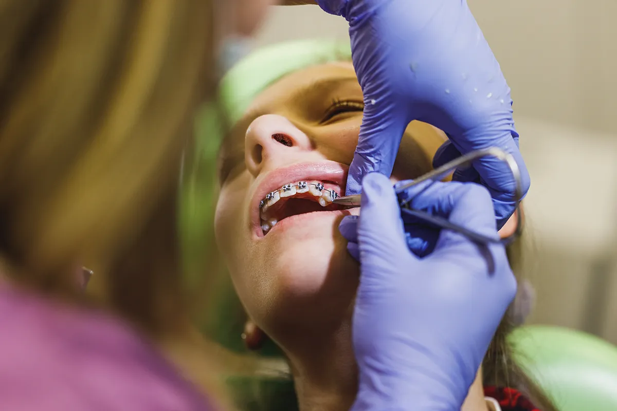 A dental professional in purple gloves adjusting metal braces on a patient's teeth