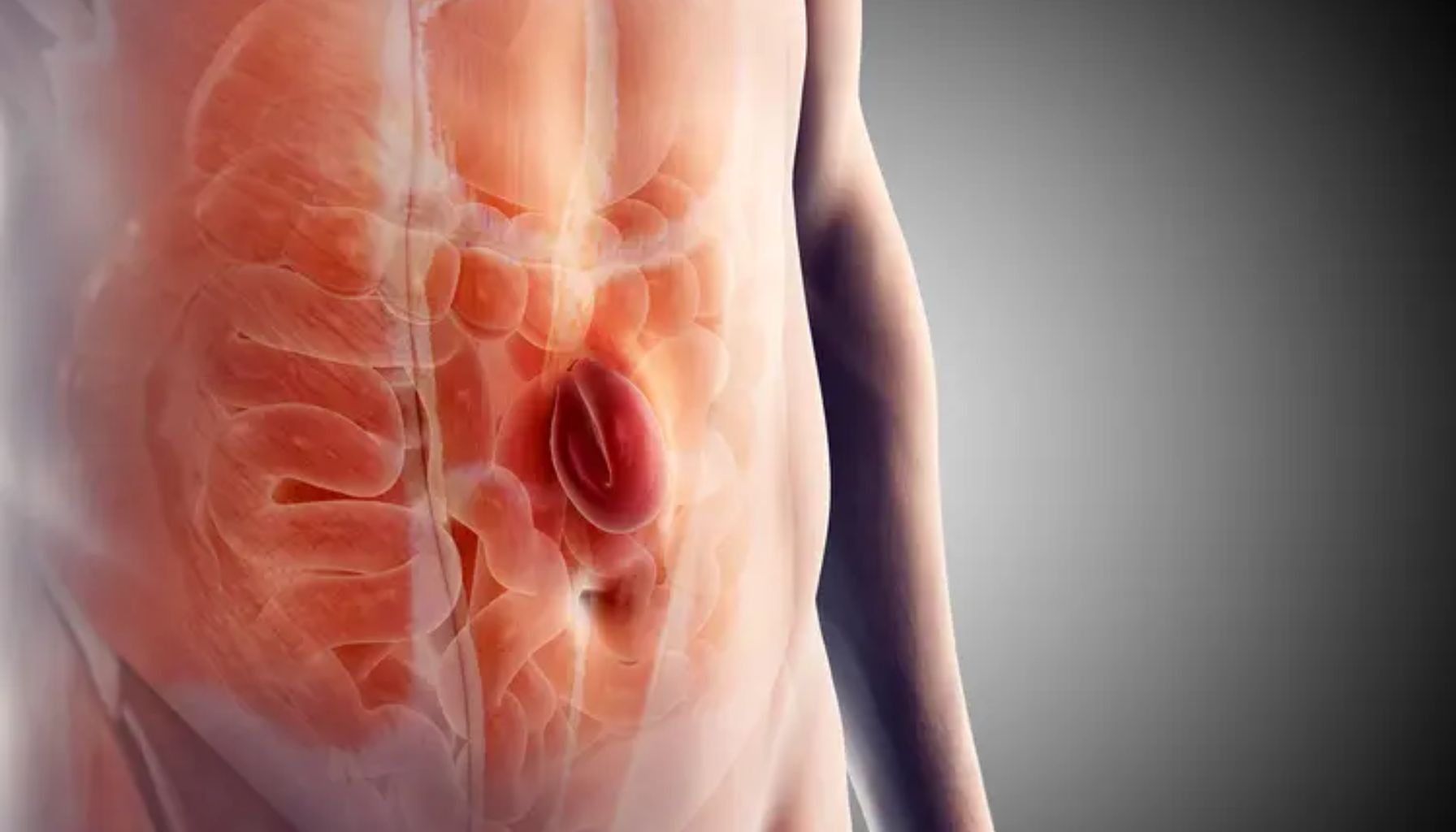 Brokk – Symptomer, typer og behandling 12 "Illustrasjon av menneskekropp som viser brokk i mageregionen med fremhevet område rundt navlen."