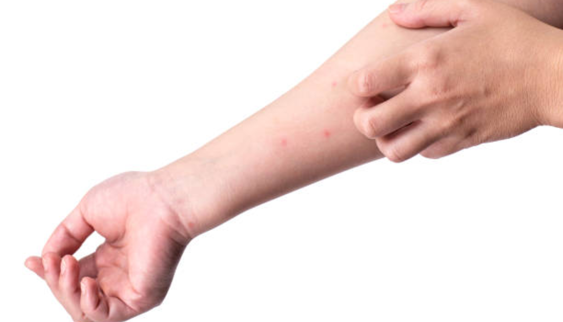 Person klør på underarm med små røde utslett, viser tegn på hudirritasjon eller allergisk reaksjon.