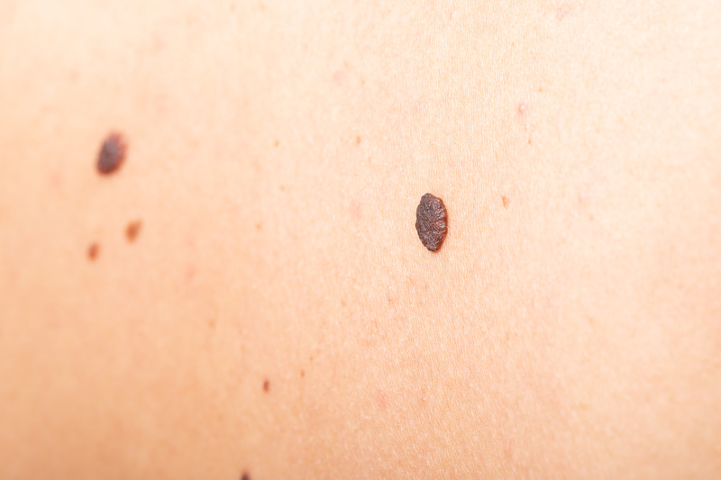 Skin Tags as Early Warning Signs of Insulin Resistance