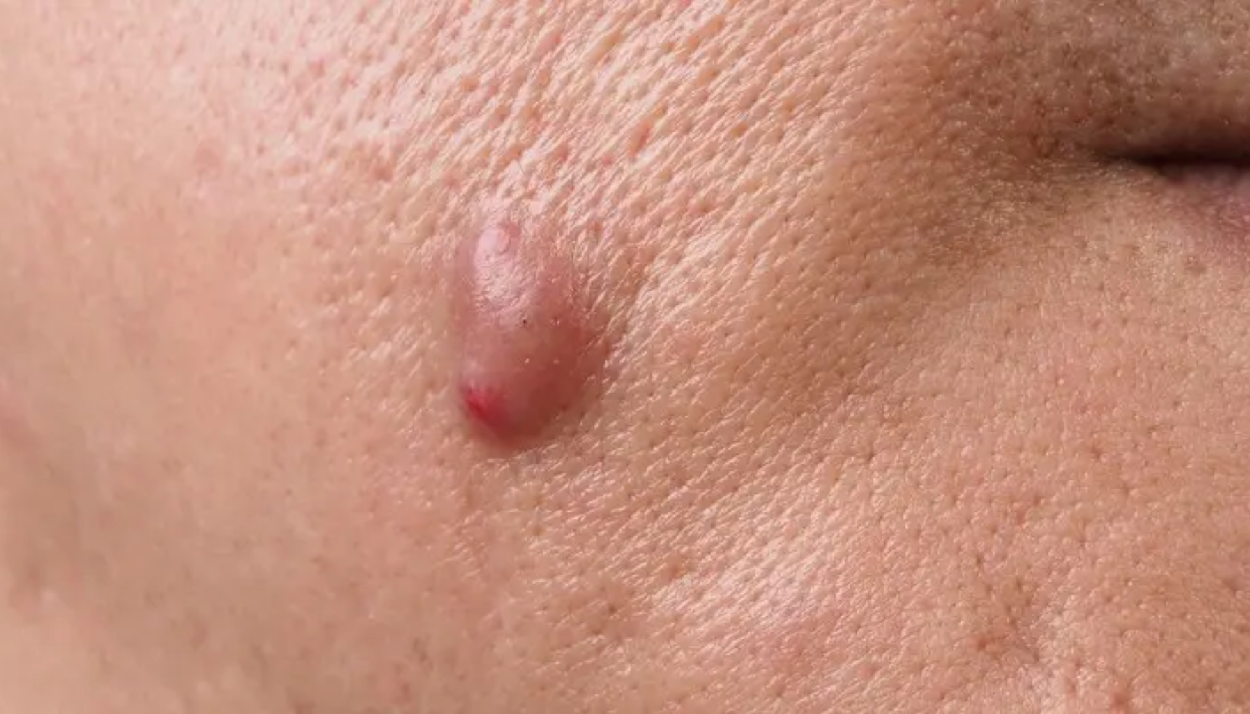 "Stor betent kvise eller cyste på kinnet nær munnområdet."