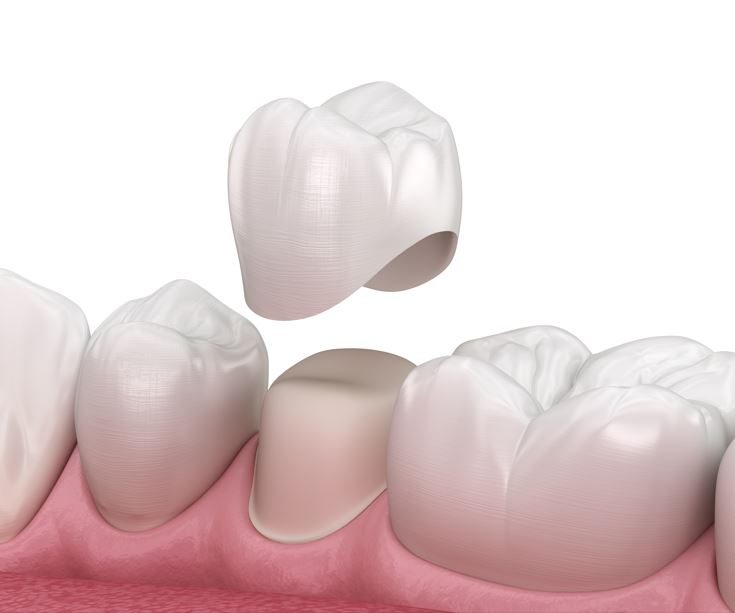 Illustration of dental crowns