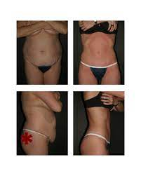 metabolic and bariatric surgery