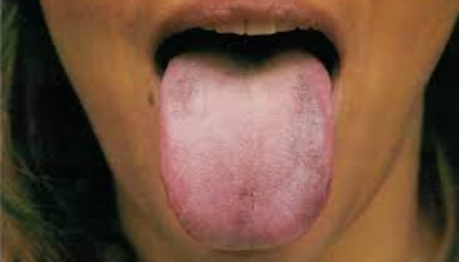 Blåtunge: Når Fargen Forteller Mer Enn Du Skulle Tro 12 Tunge med hvitt belegg og lett misfarging, som kan tyde på soppinfeksjon eller annen oral ubalanse.