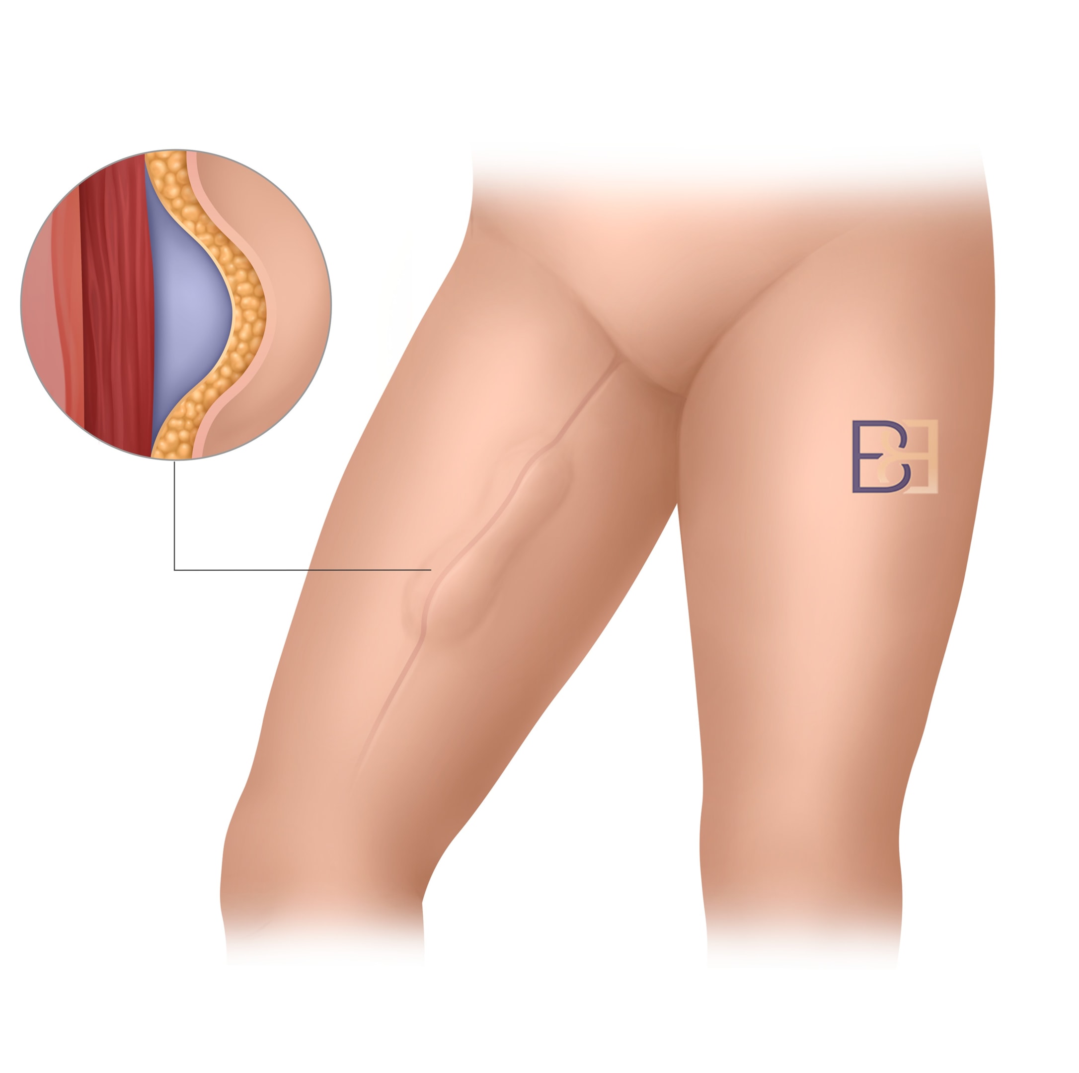 Complications After Thighplasty: Risks, Causes, and Management Options 5 Seroma in Thiplasty (inner thigh lift)