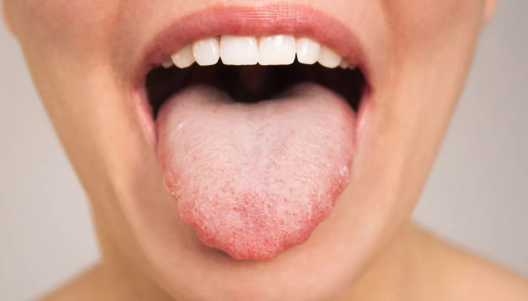 "Tunge med hvitt belegg som kan indikere dårlig munnhygiene eller soppinfeksjon i munnen." sår tunge jernmangel tegn på jernmangel rundt i kroppen lite jern nok jern røde blodceller jernmangel lav blodprosent frakte oksygen mye jern hemoglobin et protein trang til å bevege jern ta jerntilskudd sår tunge frakter oksygen gi symptomer gravide kvinner kroppen variert kosthold hele tatt bevege beina jernmangelanemi tungen symptomer tegn anemi eksempel får oksygen mer lite andre hos røde nok tunge kvinner hemoglobin føre bør kosthold mangel legen rundt ofte symptomene sår vitamin mindre blodet brennende årsaker blodmangel hud munnen mye viktig hodepine gjøre vanlig utvikle årsaken sykdommer skyldes barn spesielt hår gjør utsatt flere tid dårlig under matvarer oppstår hele tilfeller inneholder munn sykdom