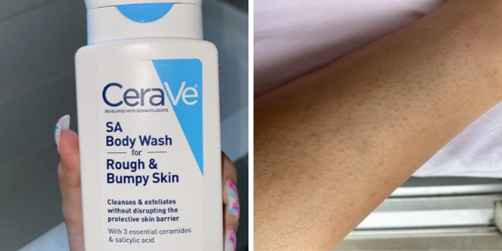 Finding the Best Body Wash for Keratosis Pilaris