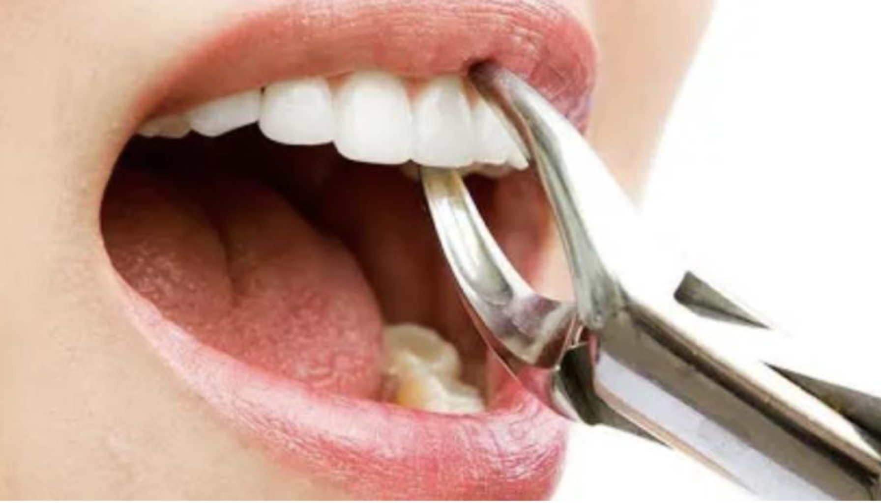 Nærbilde av tannlege som bruker tang for å trekke en tann fra en pasients munn under en tannbehandling.