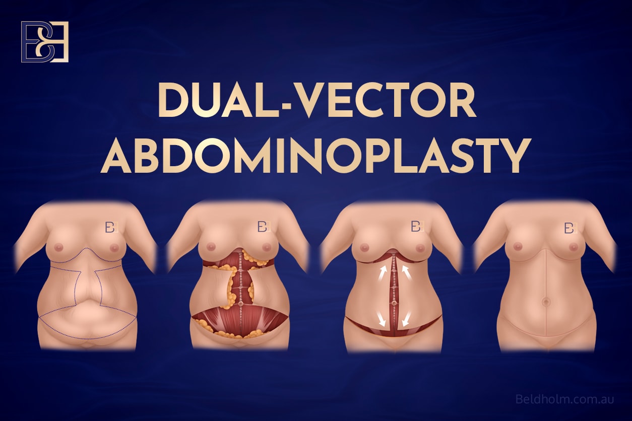 Dual vector abdominoplasty