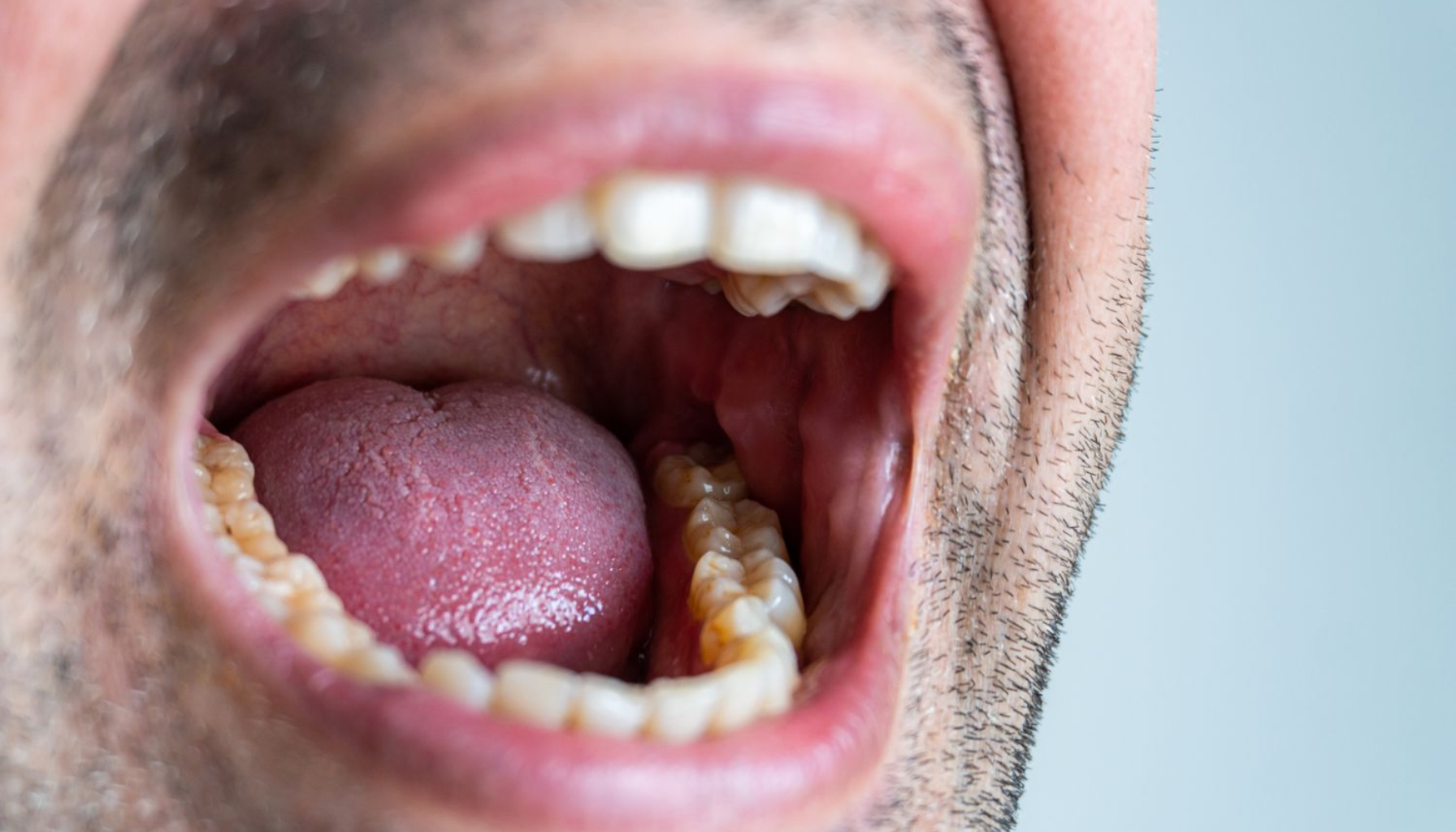 Nærbilde av åpen mannsmunn som viser tenner, tunge og svelg. Fokus på munnhygiene og mulige tannproblemer eller betennelse i munnens bakre del. røde symptomene hjelpe nødvendig opplever artikkelen medisiner behandle gjøre halsen får
