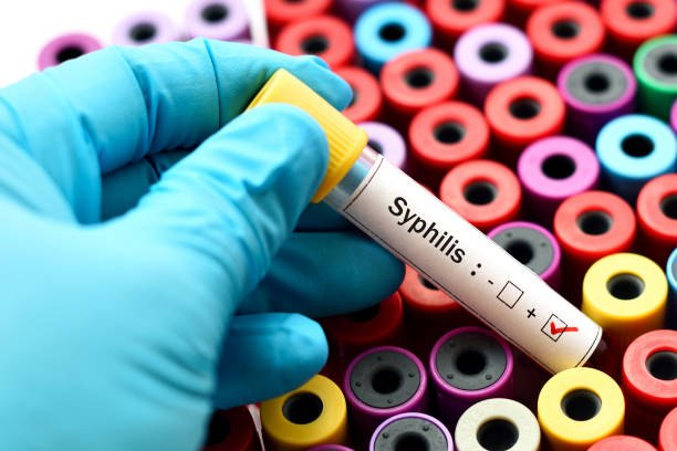 syphilis is one of the most common sexually transmitted diseases and can be passed to others through a sexual partner 