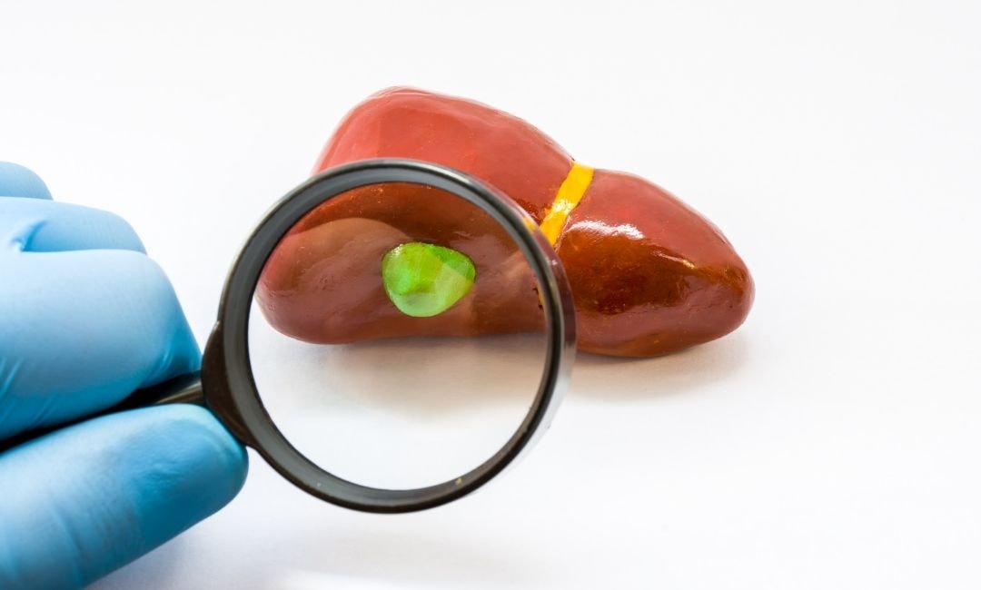 Life Without a Gallbladder
