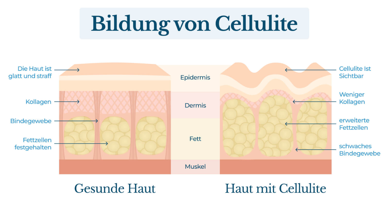 Bildung von Cellulite