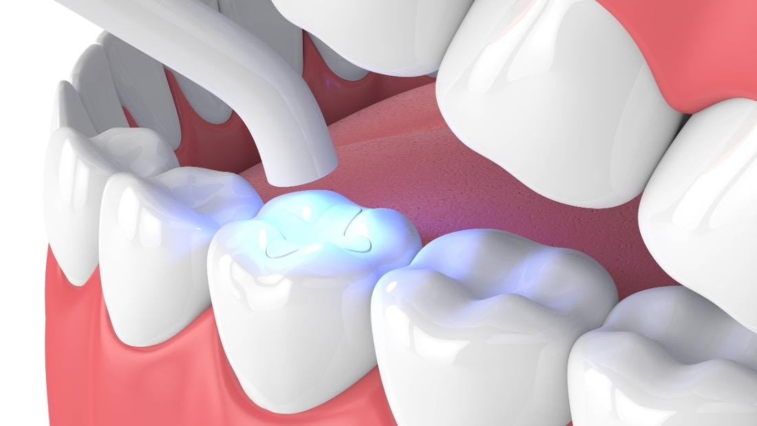 Aftercare And Maintenance for composite filling