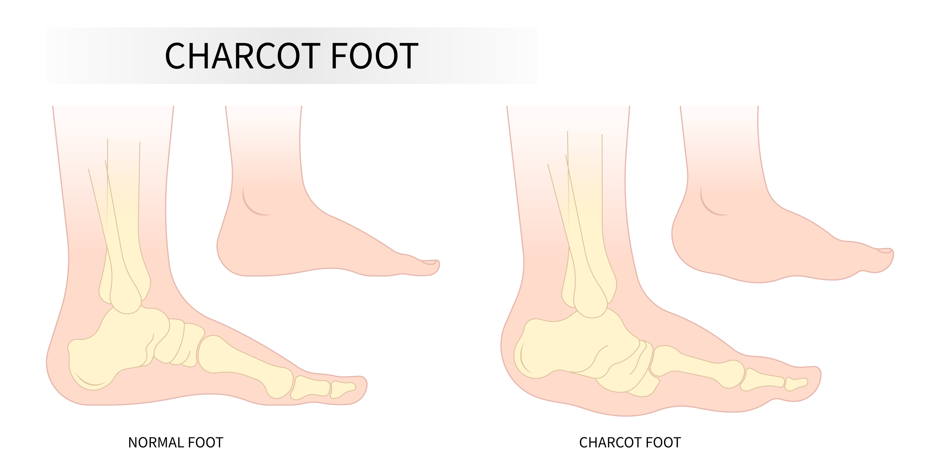 Charcot foot