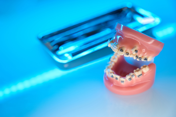 dental model showing how braces can also fix jaw alignment problems