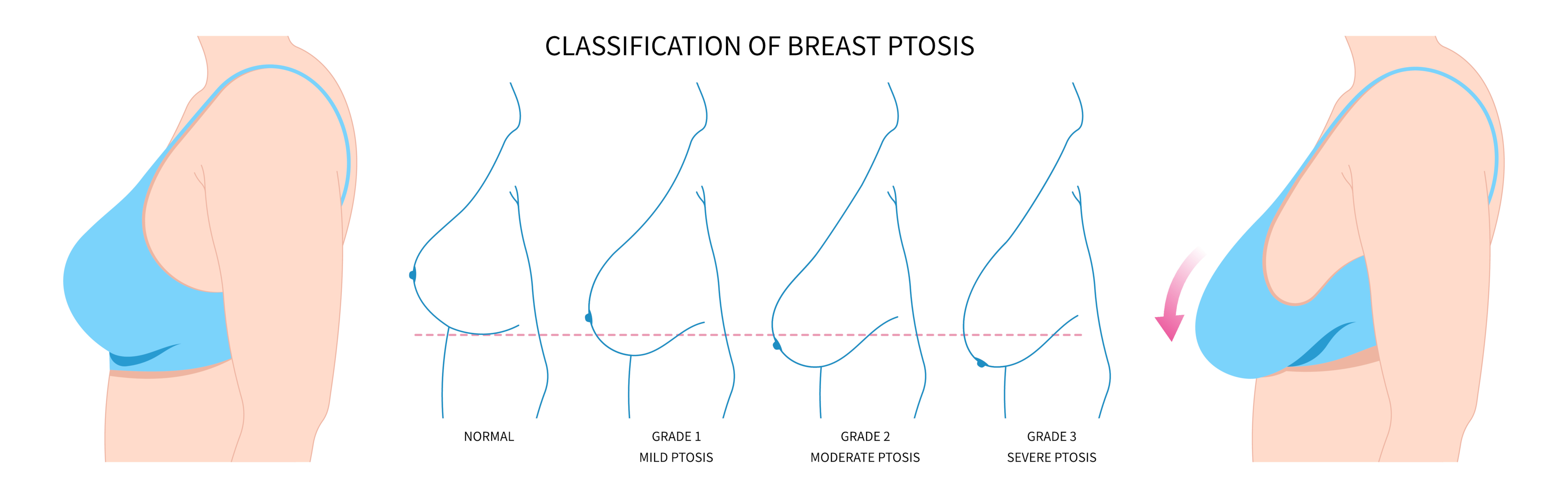 Una imagen que muestra los resultados de un procedimiento de levantamiento de senos sin implantes, ideal para aquellas que buscan una alternativa no quirúrgica".