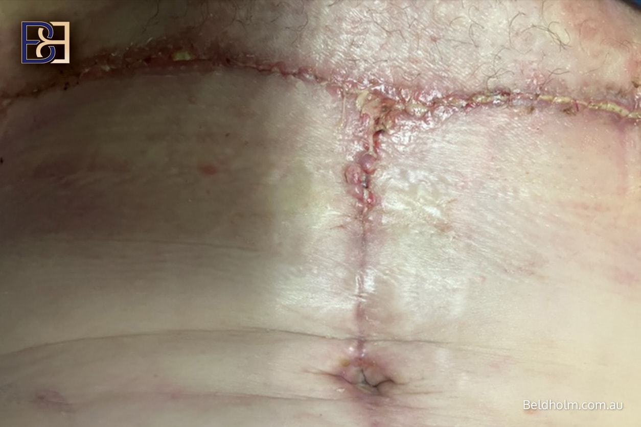 Complications from Bra Lift (Upper Back Lipectomy) post weight loss 6 fa9cfa0b 38cd 44e3 9902 957c6461df08