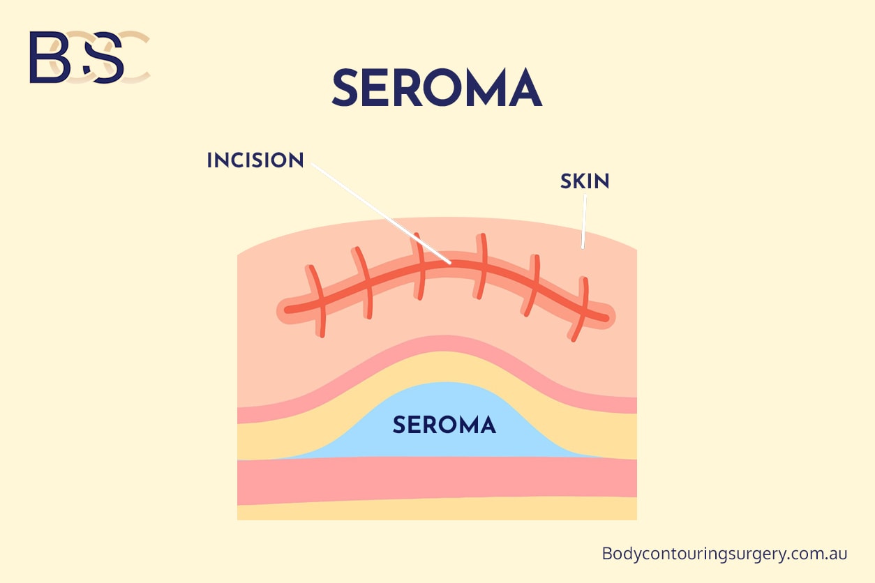 Seroma