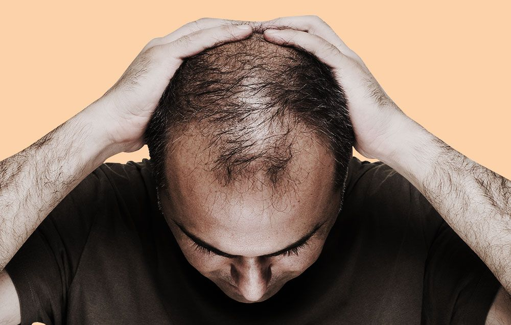 Men's hair loss solution with male pattern same to female pattern hair loss that has no relation to heart disease or hair cut