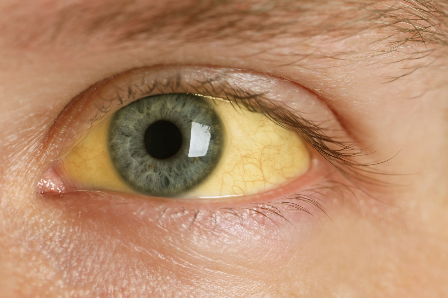 Man with jaundice in the eyes.