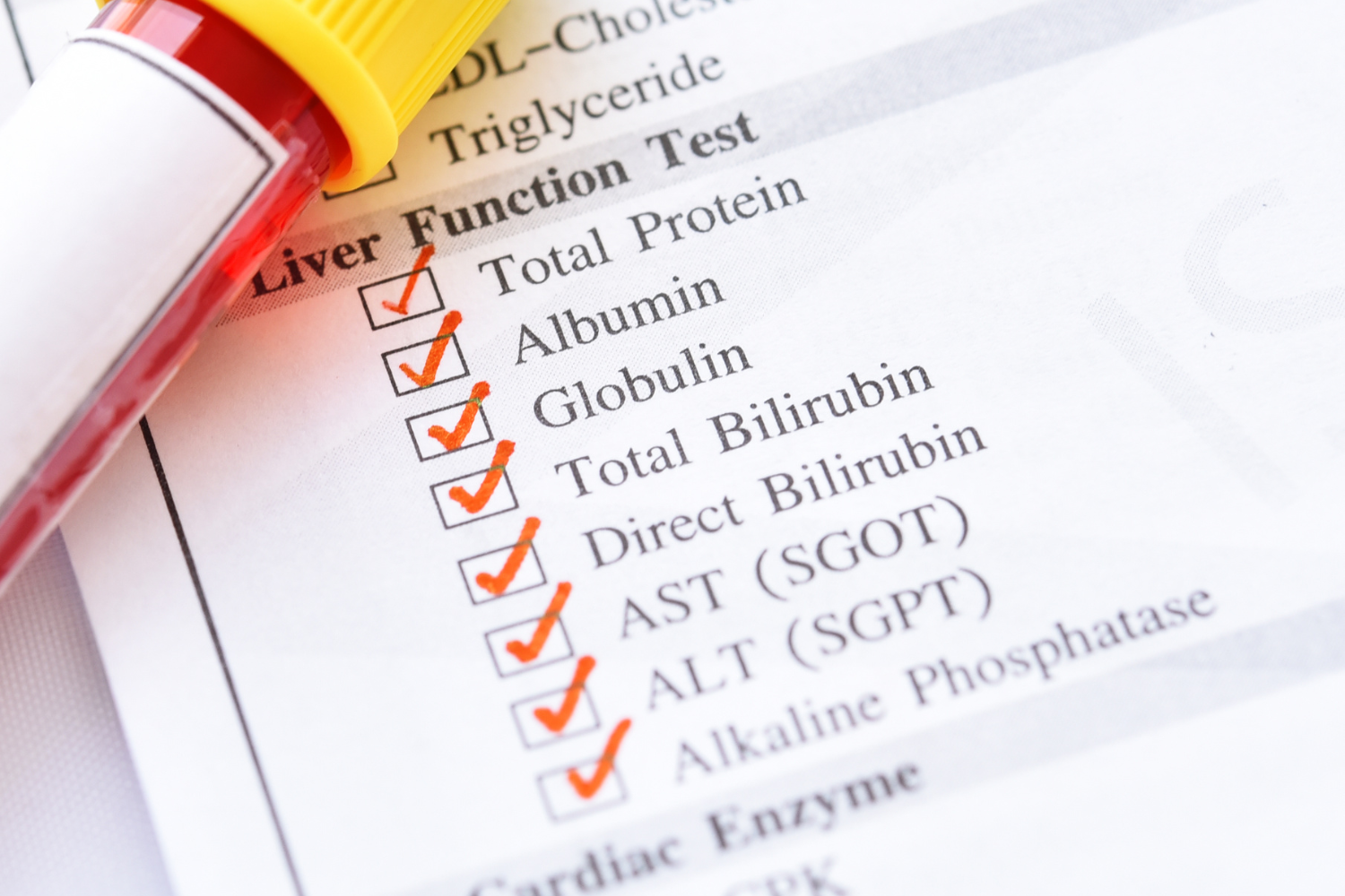 Blood test tubes labeled for liver function tests.
