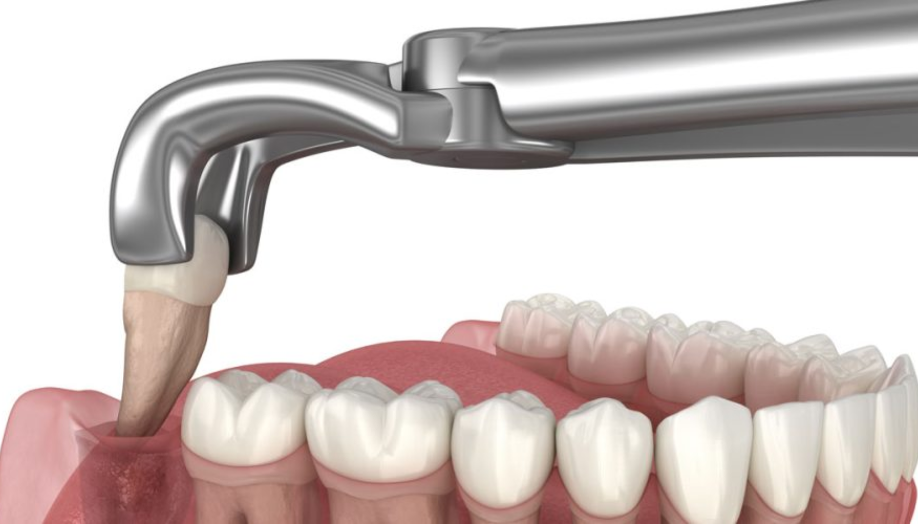 Fjerne veke etter visdomstann: Når og hvordan det gjøres trygt 9 En tann trekkes med en tang i en illustrasjon som viser hvordan tannen løsnes fra kjevebenet.