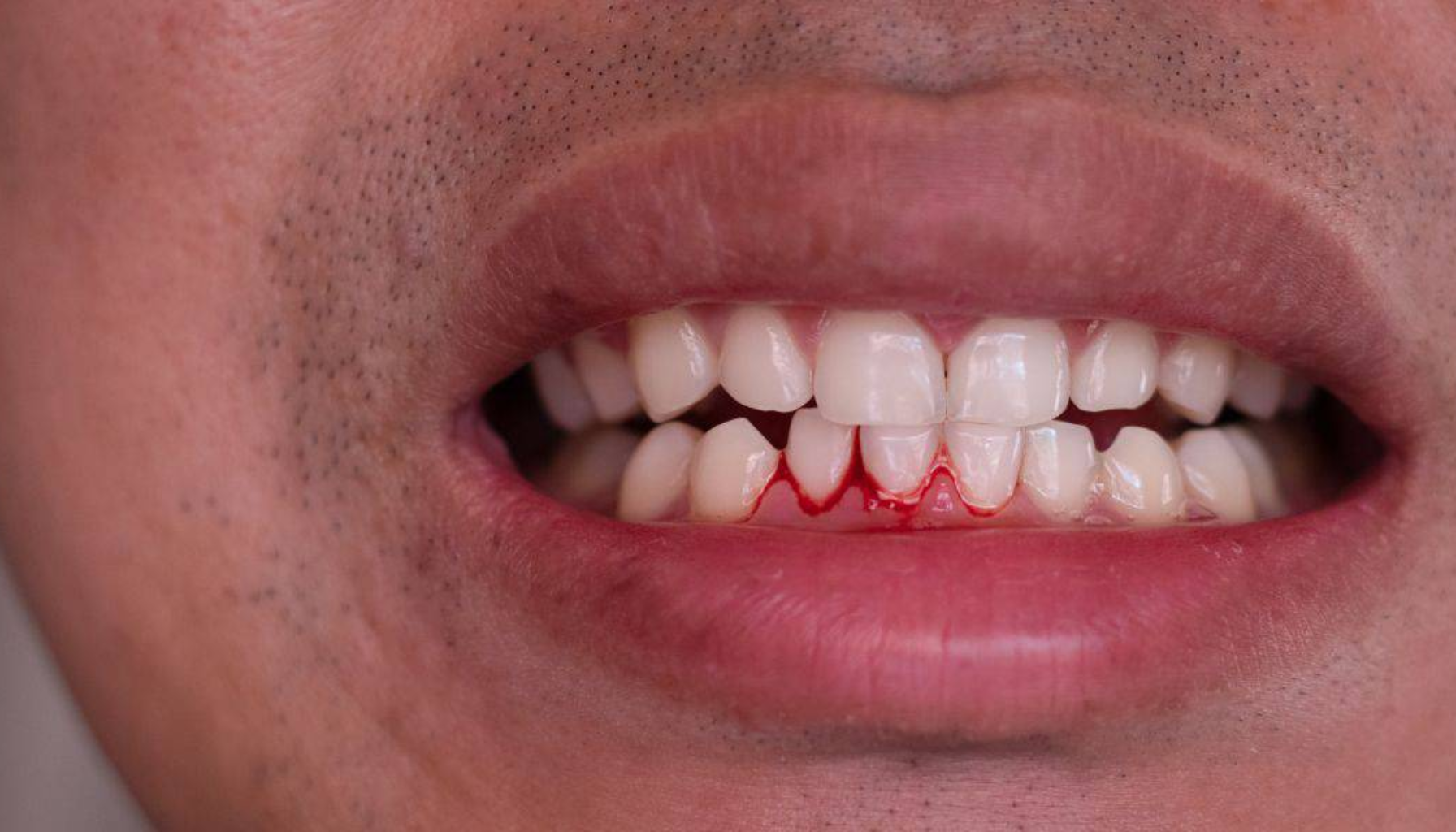 Blødende Tannkjøtt: Kroppens Tidlige Varsellampe 12 Nærbilde av mann med blødende tannkjøtt ved nedre fortenner, med delvis åpne lepper og mørk hud.