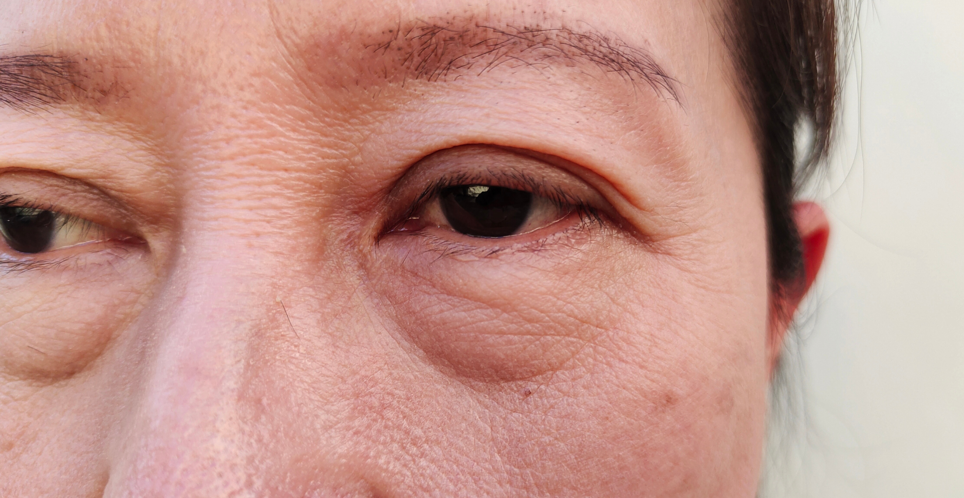 Augenringe und Schwellungen sind ein Hinweis, Diagnostik zur Ursachensuche in Anspruch zu nehmen
