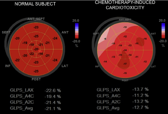 GLPS after chemotherapy