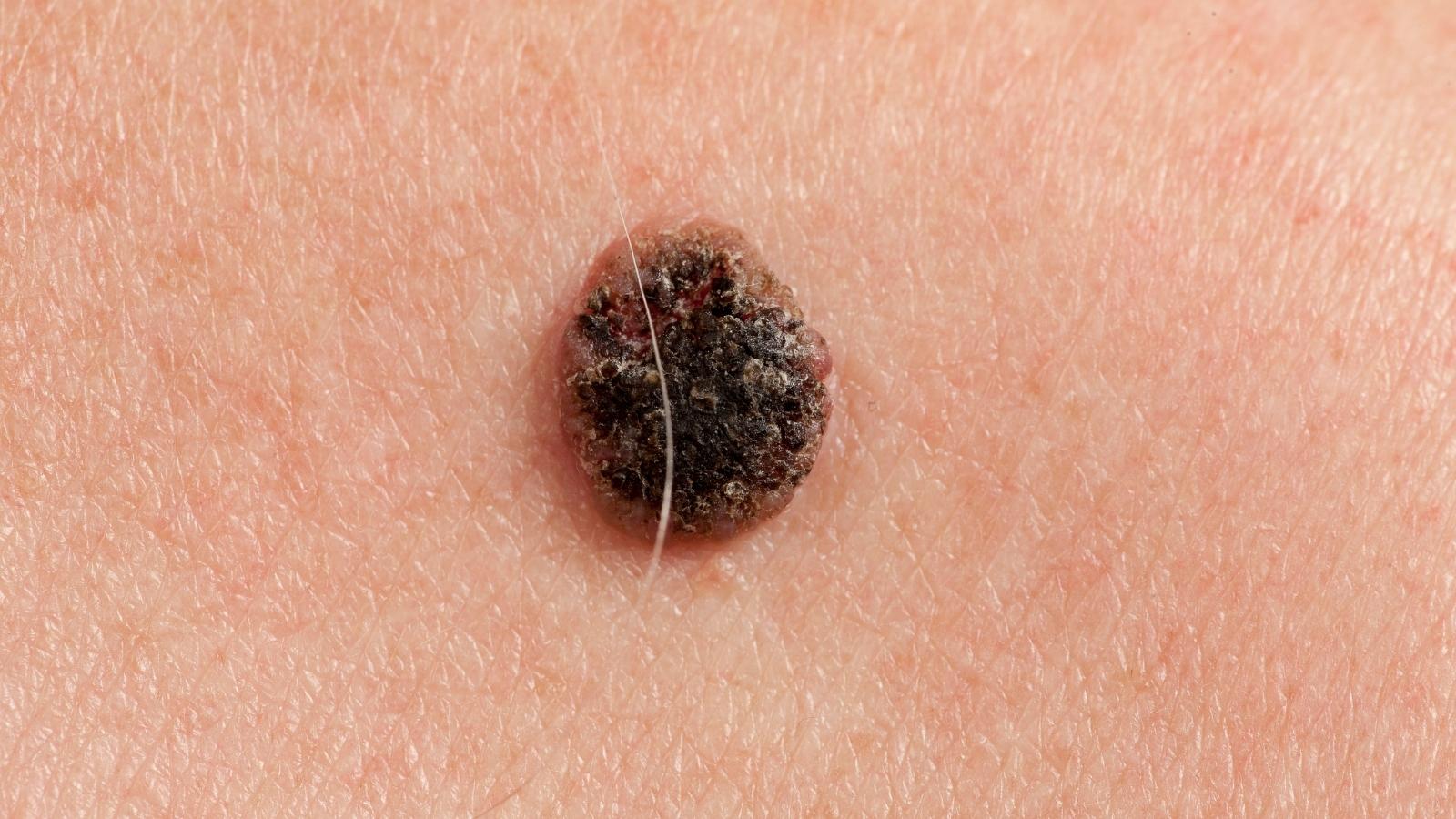 Squamous Cell Carcinoma