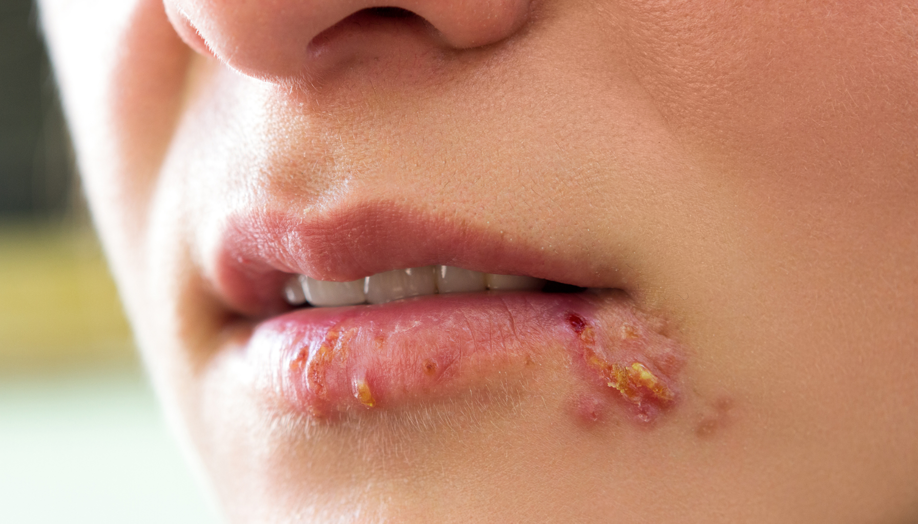 Nærbilde av munn med sår og skorper rundt leppene, typisk for forkjølelsessår.» herpes genital herpes herpes simplex virus herpes simplex finnes to typer hsv 1 hsv 2 herpes er svært vanlig resten av livet nye utbrudd første utbrudd rundt munnen gjennom spytt herpes er svært herpes genitalis type 2 hud og slimhinner kroppen resten av livet seksuelt overførbare infeksjoner type 1 to typer utbrudd med sår smertefulle blemmer herpes i underlivet rundt kjønnsorganet utbrudd får utbrudd blemmer og sår bruk av kondom 1 og hsv 2 svært vanlig utenom utbrudd flere ganger én gang smertefulle sår genital første utbruddet seksuelt overførbar nedsatt allmenntilstand hyppige utbrudd bruke kondom smitte barnet reduserer smittefaren behandling oppsøke lege får smitte under fødselen smitte andre symptomer sår smittet viruset 10 dager forkjølelsessår hos ofte rundt første herpesutbrudd under underlivet finnes sårene dager svært blemmer fleste infeksjon andre smertefulle vanlig bør vanligvis gir herpesinfeksjon gjennom munnen seksuelt barn