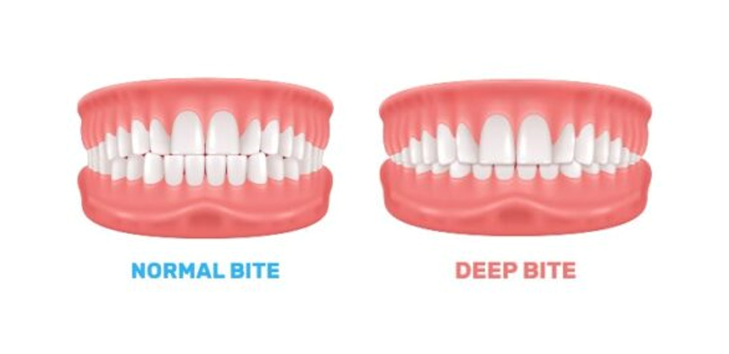 Normal vs Deep bite
